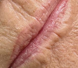 Vor der Korrekturbehandlung