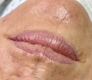 Vor der Korrekturbehandlung