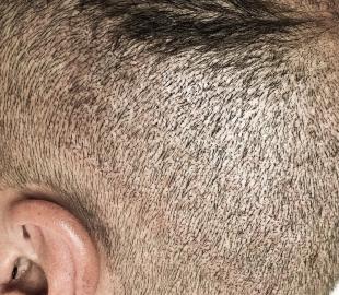 Direkt nach der Behandlung