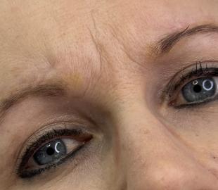 Vor der Korrekturbehandlung